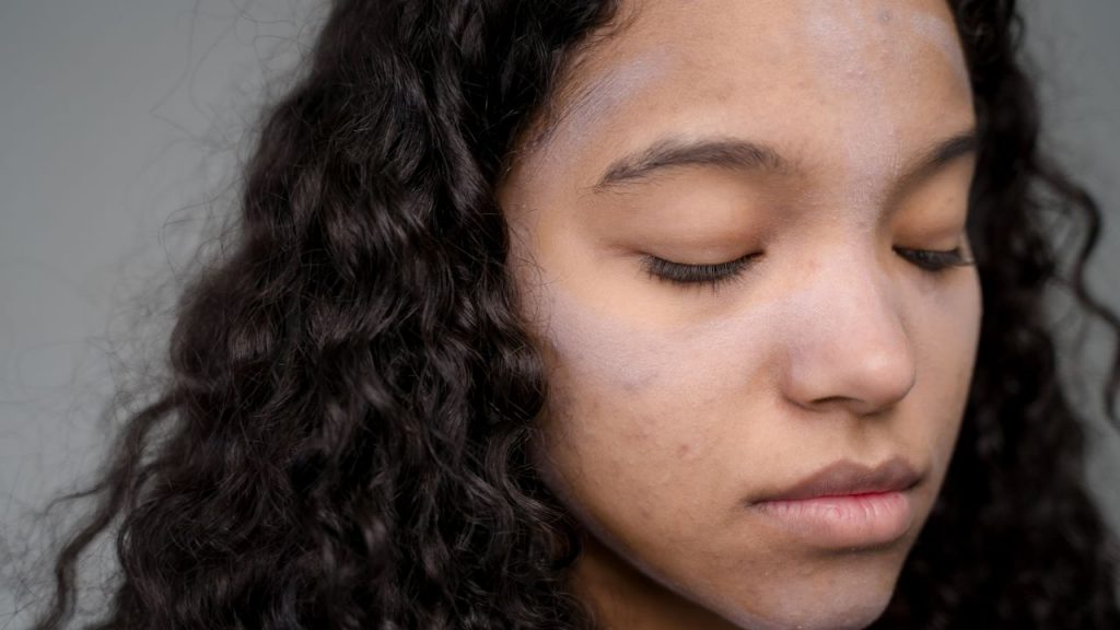 Acne adulta: condição é relacionada a alterações hormonais e estresse