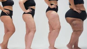 lipedema